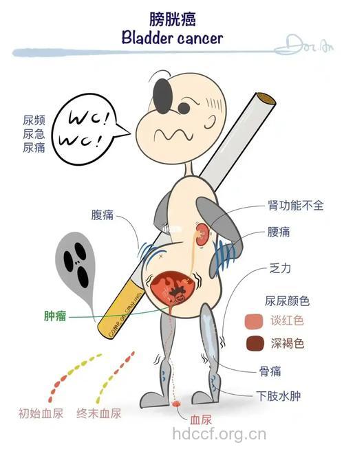 膀胱癌的早期症状有哪些