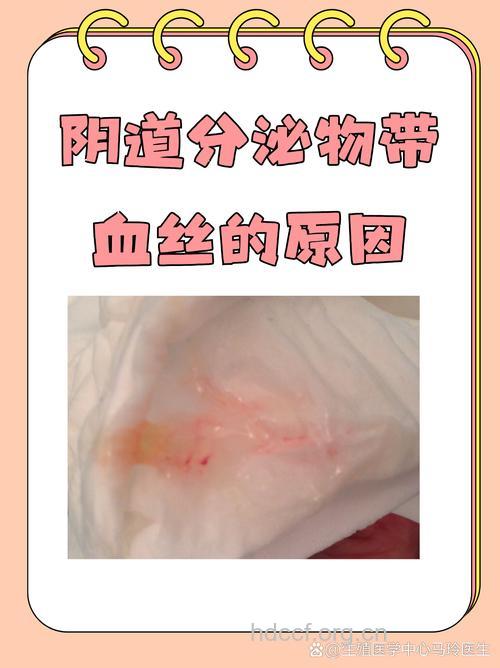 宫颈癌早期可能出现白带血丝