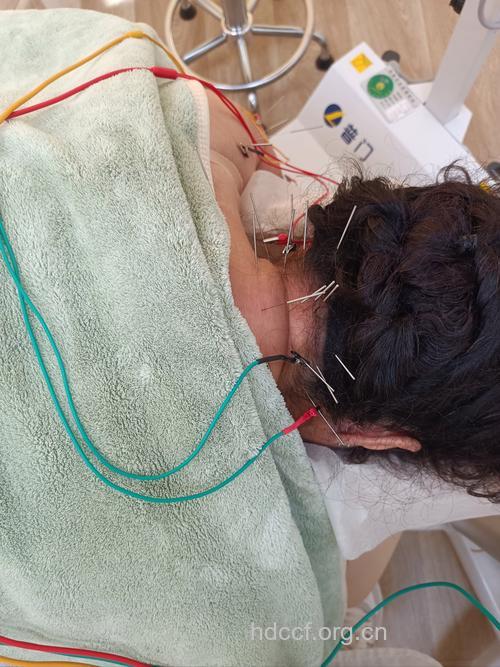 针刺可否治疗神经根型颈椎病?