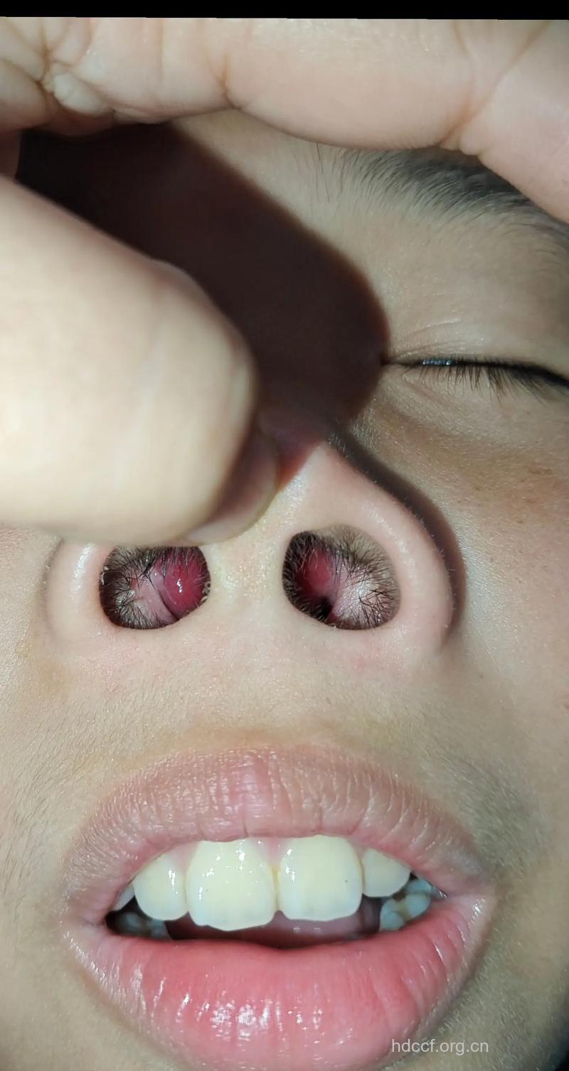 鼻息肉的症状是什么呢