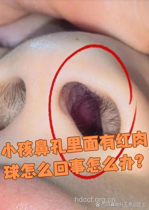 鼻息肉有哪些症状表现呢