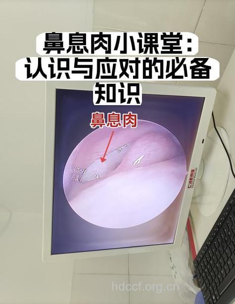 鼻息肉术前有哪些准备工作