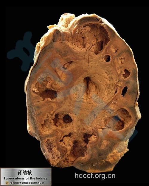 疾病百科 看看肾结核是什么样的