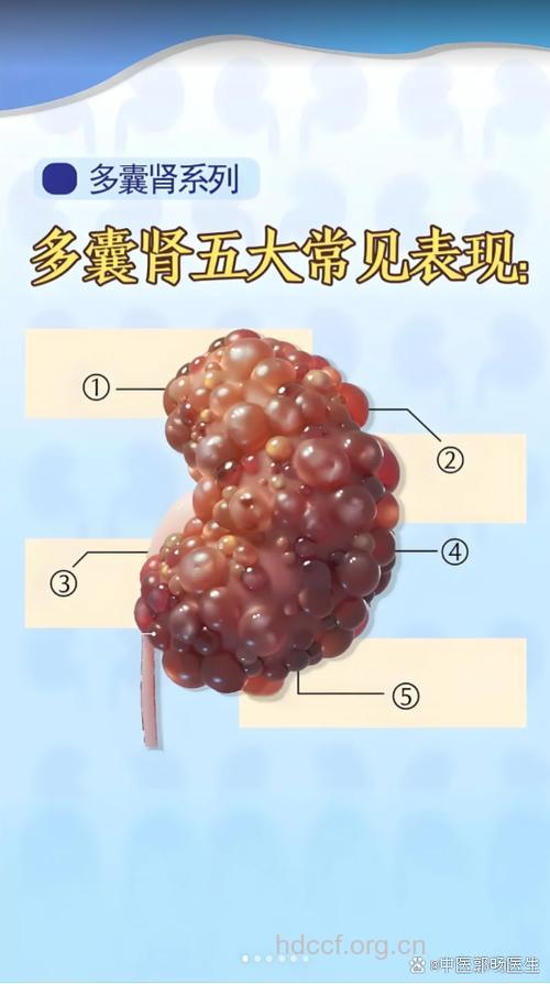 多囊肾常见的四大表现