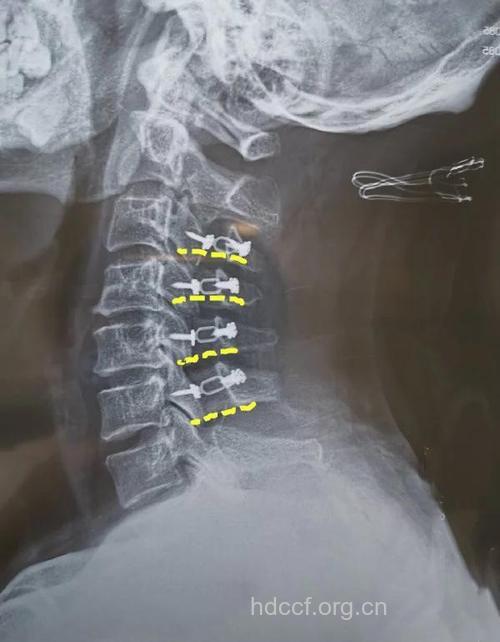 那些情况的颈椎病应尽早手术?