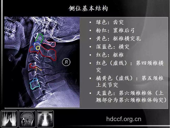 教你如何从X线片看懂颈椎病