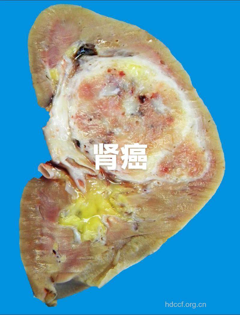 疾病百科 一起看看肾脏肿瘤