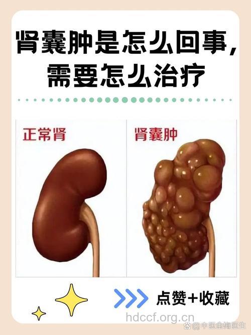 疾病百科 肾囊肿是种什么疾病