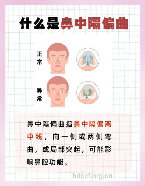 什么是鼻中隔偏曲 它有什么危害