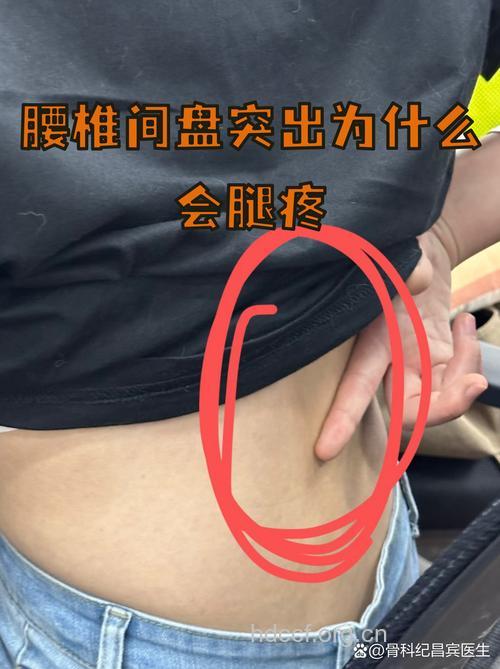 大腿后方疼痛或因腰椎间盘突