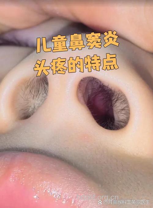 小孩子鼻窦炎有哪些症状