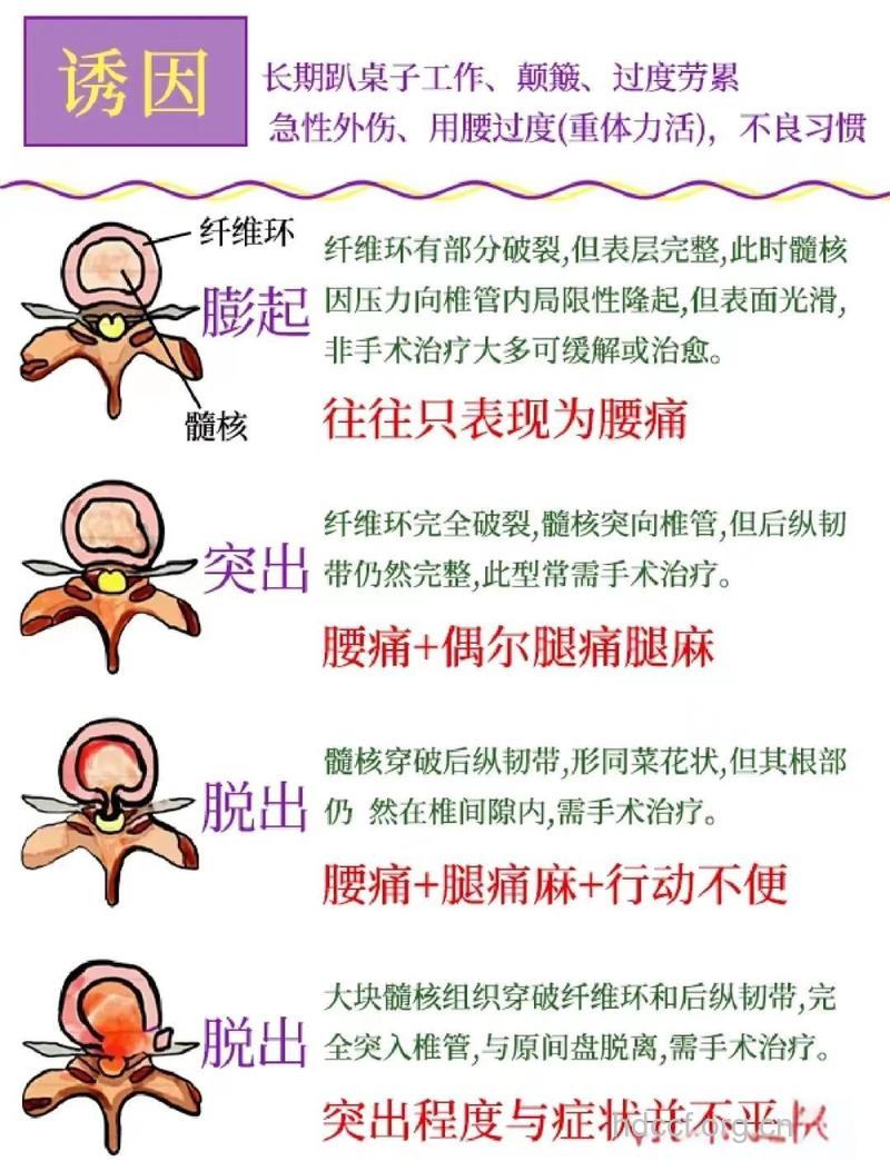 腰椎间盘突出临床具体的病因