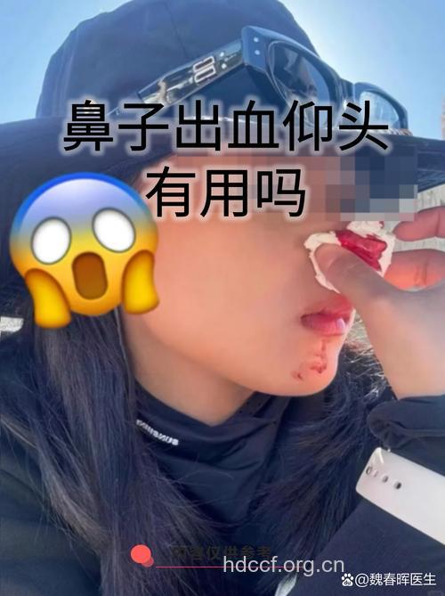葱汁可止鼻出血？