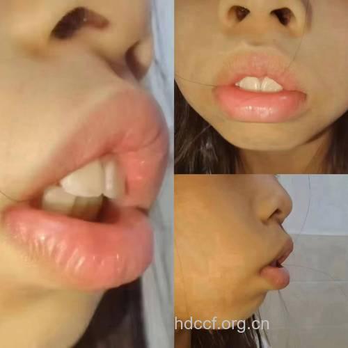 张口呼吸易造成下颌畸形