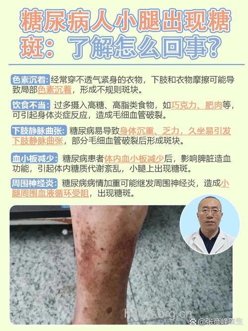 糖尿病肾病有哪些肌肤异常