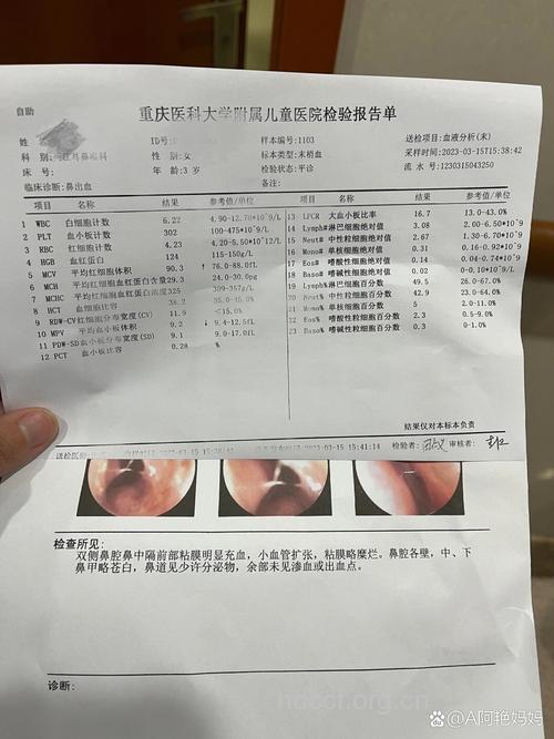 经常流鼻血 做个血常规检查