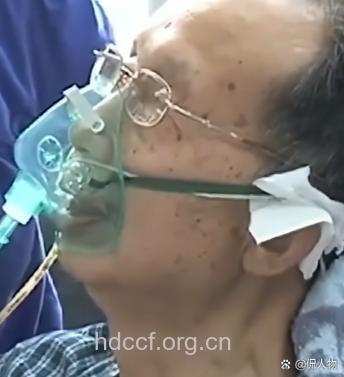 暗藏杀机的老人鼻出血