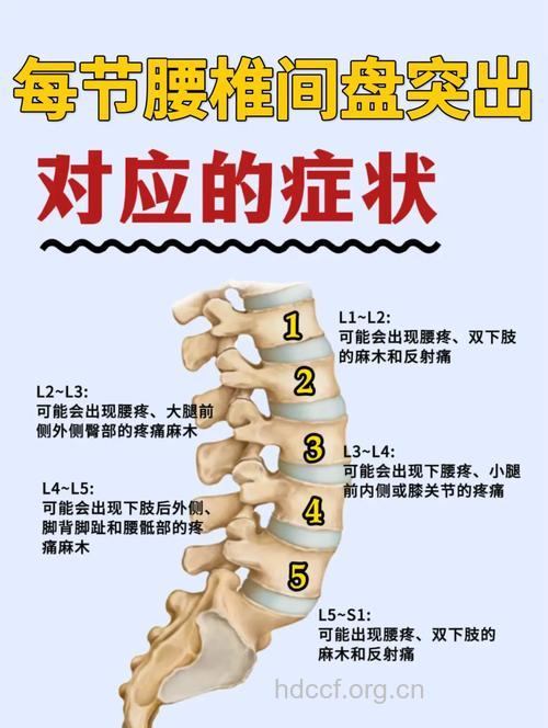 腰椎间盘突出会有什么症状呢