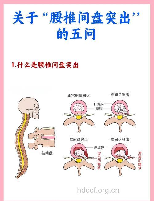 腰椎间盘突出发病机制是什么呢