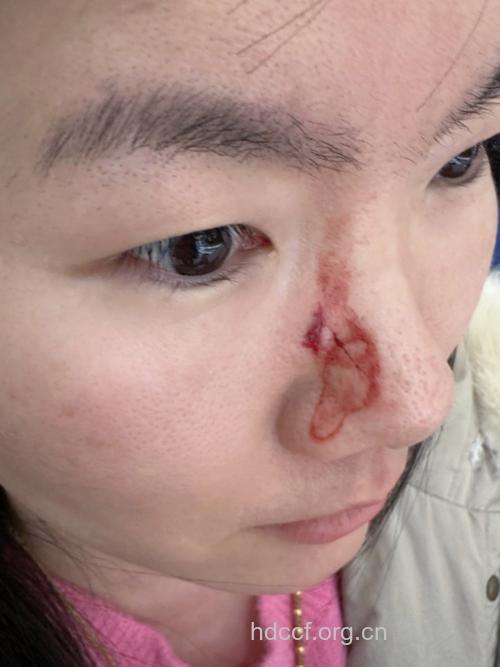 留心鼻子受到的伤害