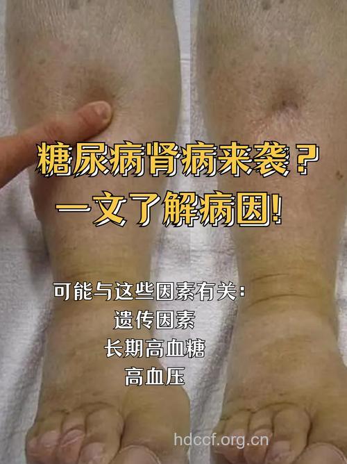 糖尿病肾病的伴发病症