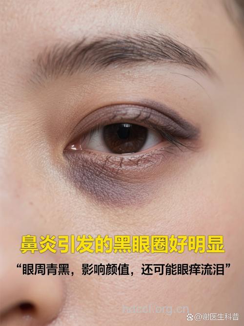 “熊猫眼”引起鼻炎？！