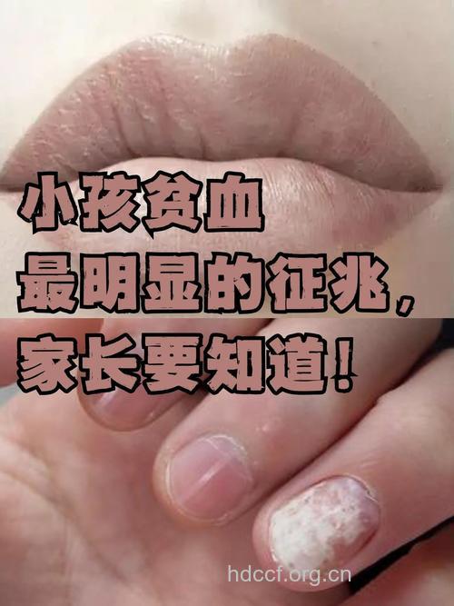 孩子贫血水肿 或是肾病的前兆