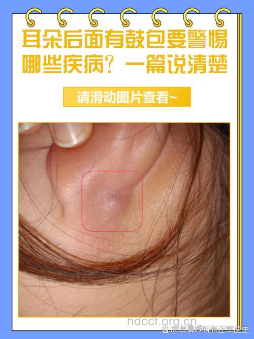 耳朵后面长了个硬包怎么办