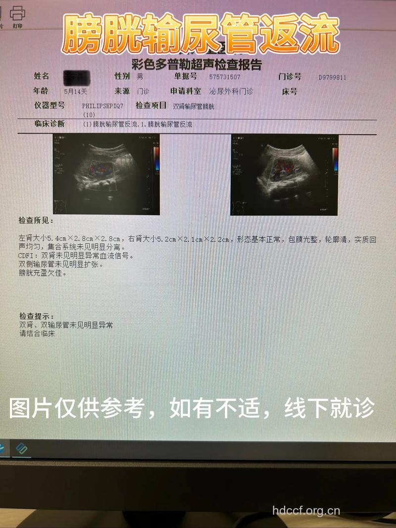 预防儿童肾病 尿检彩超应进儿童体检