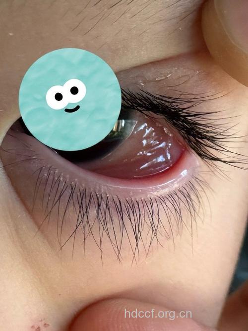 宝宝水泡眼可能是肾炎