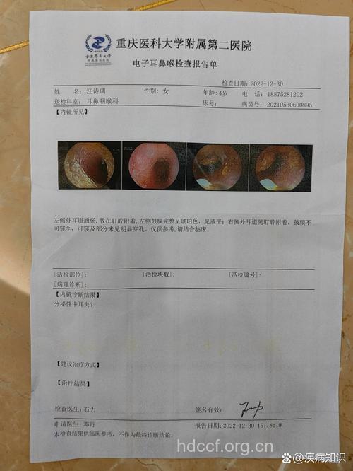 急性化脓性中耳炎有哪些检查项目