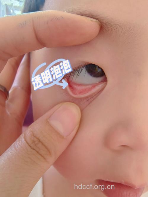 水泡眼是宝宝肾病早期信号吗