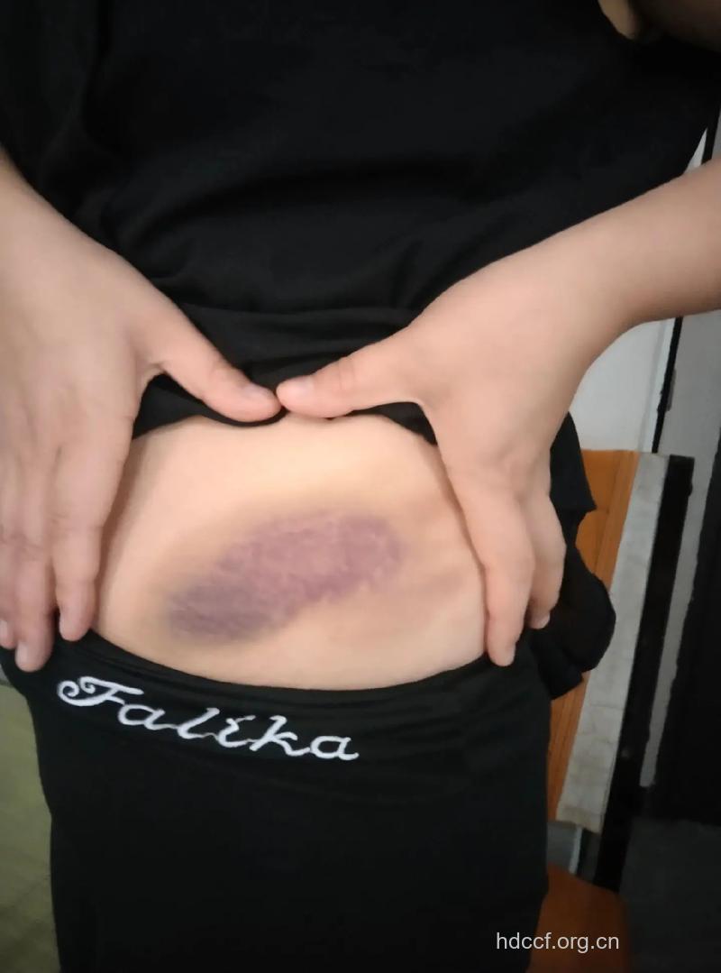 猛摇呼啦圈容易造成腰部扭伤