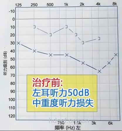 药物性耳聋的3个早期信号