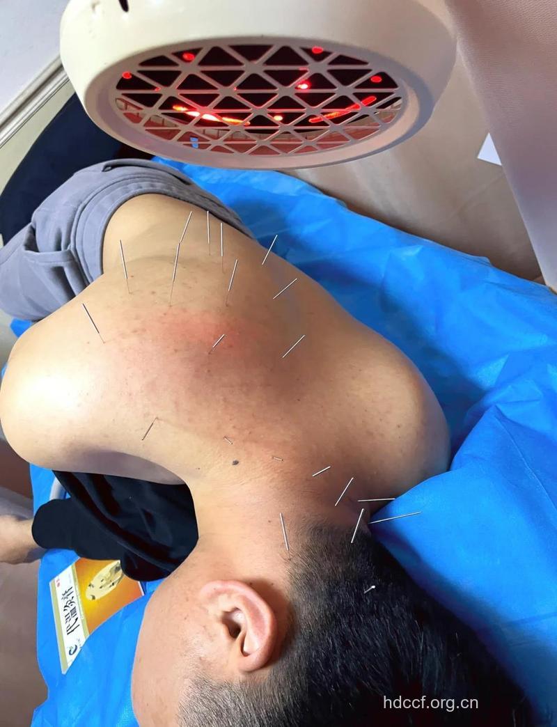 针灸治疗急性腰扭伤