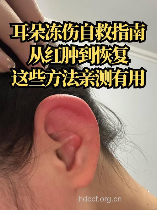 冬季耳朵长冻疮怎么办