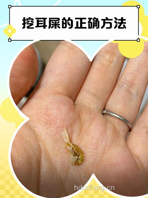 耳朵耳屎到底能不能挖