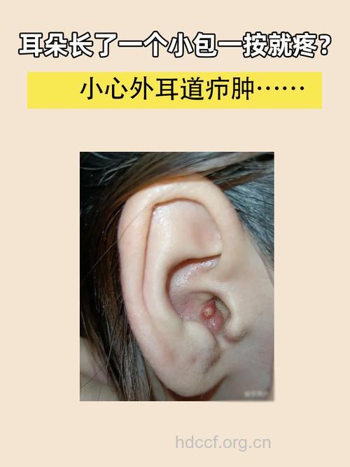 挖耳也能挖来外耳道疖