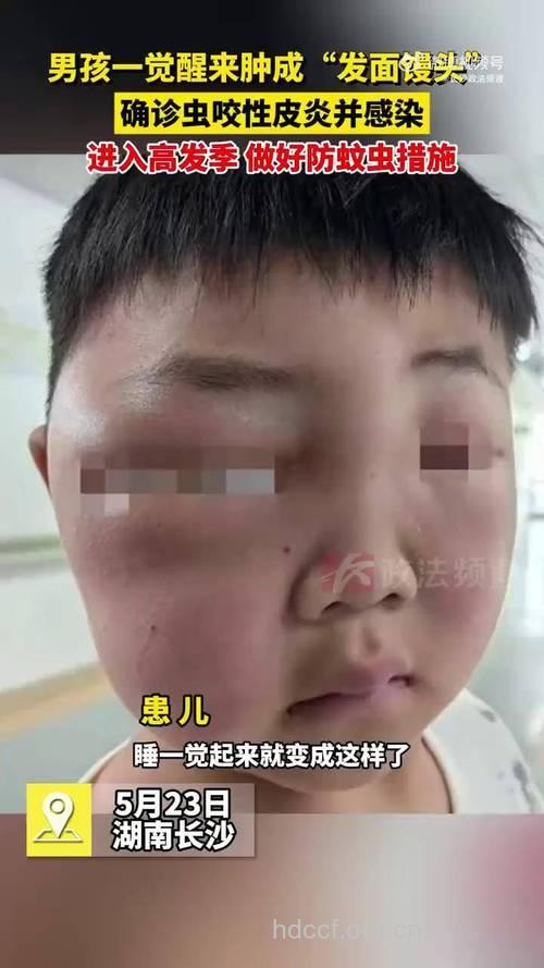 宝宝颜面浮肿 警惕小儿肾病