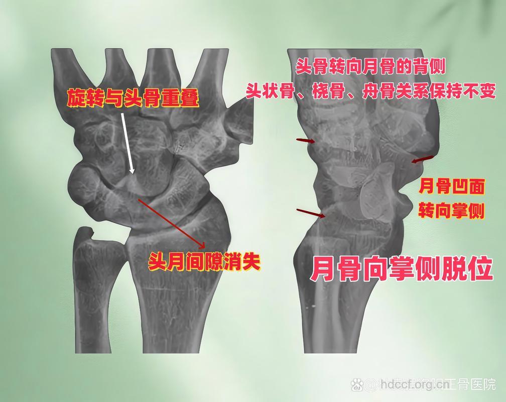 怎么区别诊断舟月骨分离与月骨脱位