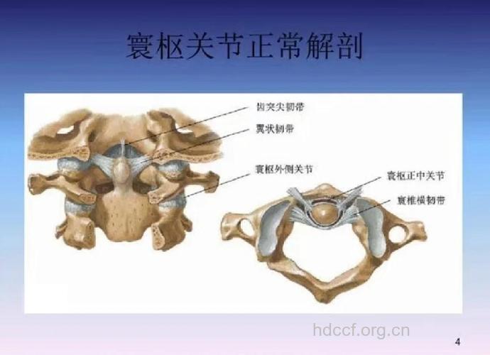 如何诊断寰枢关节脱位