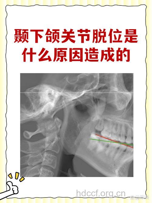 为什么会导致颞下颌关节陈旧性脱位