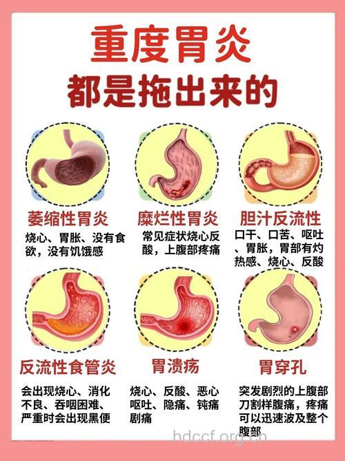 急性胃炎如何预防与调养