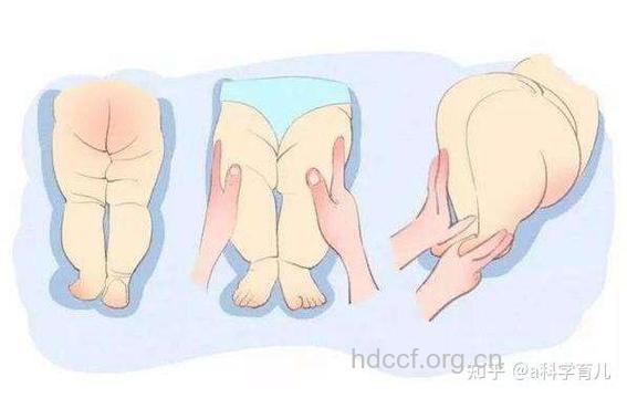 孩子走路歪扭须防髋关节脱位