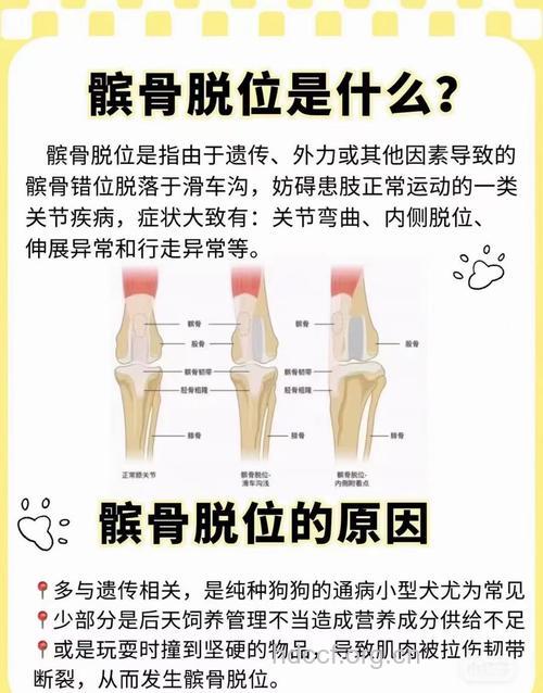 关节脱位的正确认识
