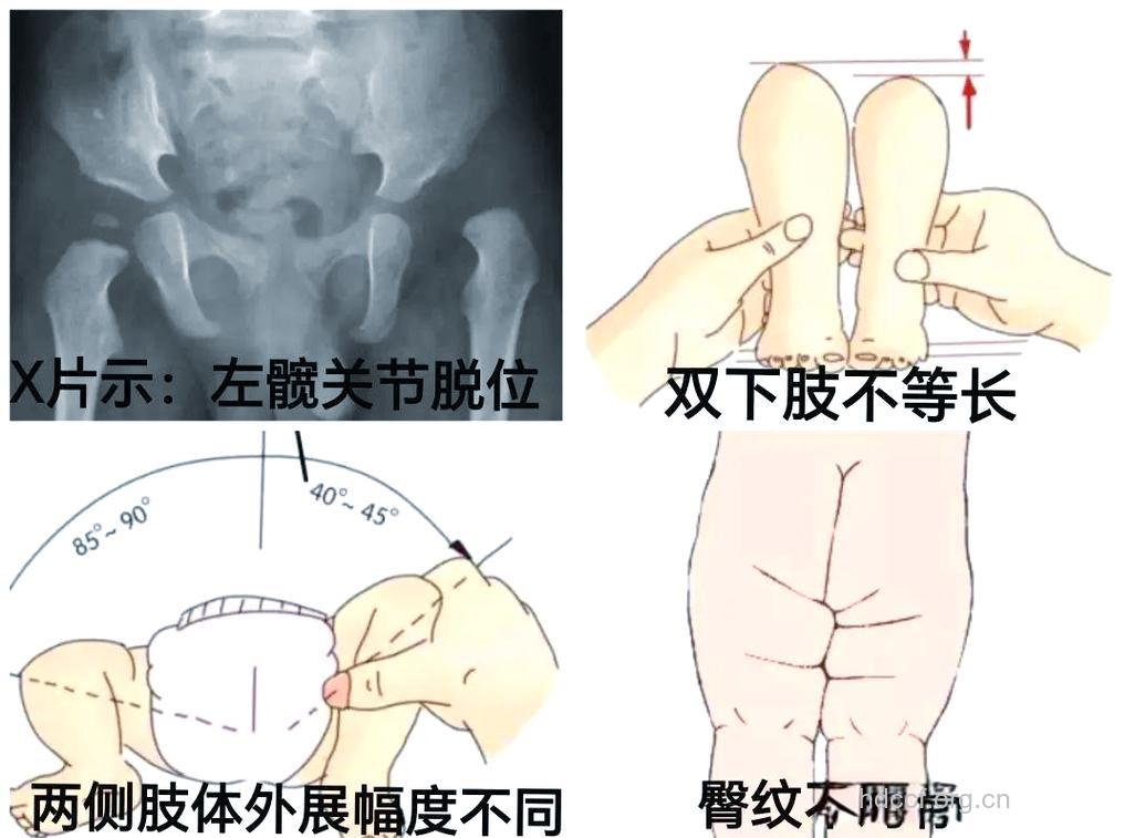 提防小儿先天性髋脱位