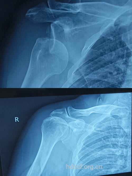 肩关节脱臼的X光片
