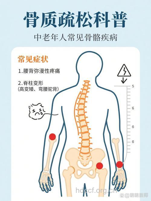 4大典型的骨质疏松症状