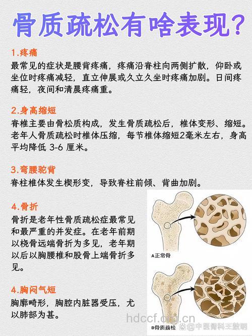 关于骨质疏松的四大症状