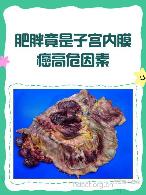 肥胖不孕者易得妇科癌